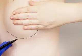 Le lipofilling mammaire : ce que vous devez savoir avant de prendre votre décision