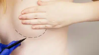 Le lipofilling mammaire : ce que vous devez savoir avant de prendre votre décision