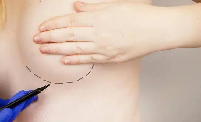 Le lipofilling mammaire : ce que vous devez savoir avant de prendre votre décision