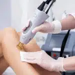 epilation définitive