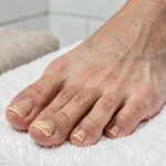 Gros plan sur des ongles d'orteils épaissis et jaunis posés sur une serviette blanche, illustrant les symptômes visuels d'une mycose ou d'une kératose unguéale