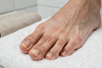 Gros plan sur des ongles d'orteils épaissis et jaunis posés sur une serviette blanche, illustrant les symptômes visuels d'une mycose ou d'une kératose unguéale